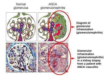 Kidney pathology finding Renal Infections Most renal infections occur via the ascending route.