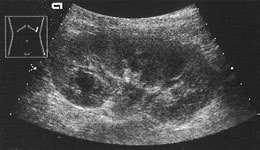 Renal Infections Acute Pyelonephritis (Acute Bacterial Nephritis) Sonographic criteria: diffuse renal enlargement.