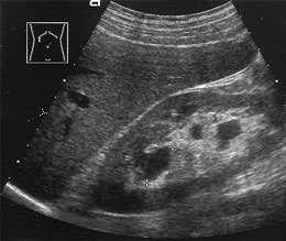 Renal Infections Renal Abscess Sonographic criteria: renal abscess is typically a round thick walled hypoechoic