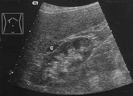 Renal Infections Chronic Pyelonephritis Sonographic criteria: The affected kidney is small lobulated due to parenchymal thinning decreased