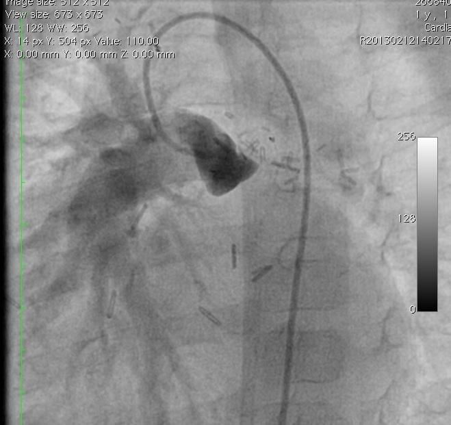 Occluded LPA in Fallot with pulmonary atresia post RtBTS and LPA patch