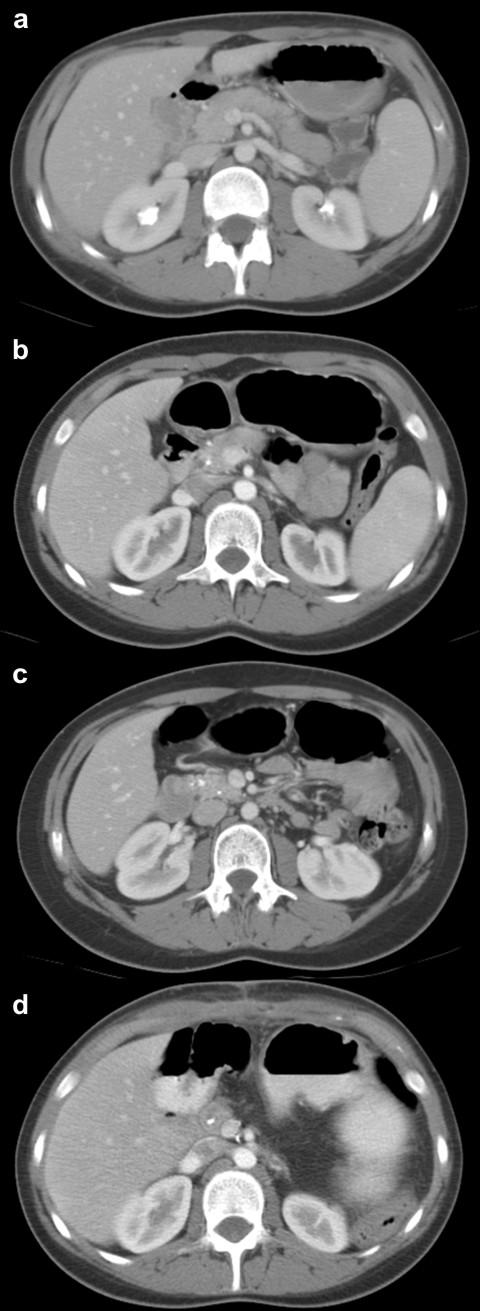 pancreatitis to include progressive calcification on CT scans (Figure 1).