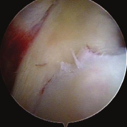 However, the labrum was attached to the fragment without avulsion and the cartilage surface at the inferior edge (6 o clock) of the fragment continued to the glenoid rim.