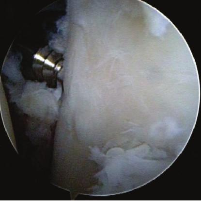 technique. Thereafter, arthroscopic internal fixation using Double-threaded Japan (DTJ) screw (Meira, Japan) was performed.