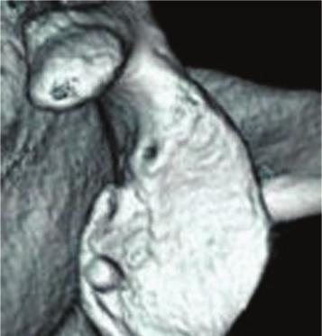 3-dimensional CT. could not be found as placed under the articular cartilage (Figure 4).