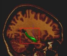 Temporal Lobe Epilepsy Lateralization Based on MR Image Intensity 369 Fig. 1. Lateralization of TLE is commonly done using hippocampal volumetry (3D segmentation shown in green).