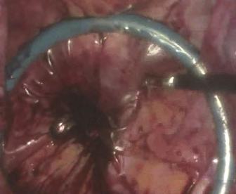 Laparoscopic Surgery: An Almost Scarless Approach 405 Fig. 5.