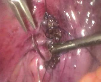 406 Advances in Endoscopic Surgery The anvil of the circular stapler is then inserted into the proximal colon and closed using purse string suture.