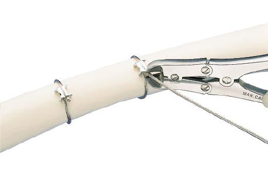 Cerclage Technique 5. Cut cable Instrument 391.905 Cable Cutter, standard or 391.