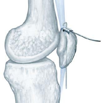 Kirschner wires (superiorly and inferiorly), over the front of the patella