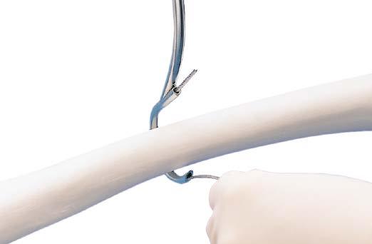 The size and shape of the cable passer selected is dependent upon the circumference of the bone and access to the site.