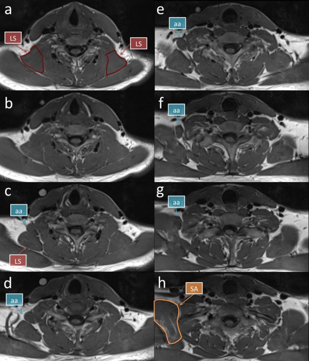 Fig. 2: MR images from superior (a) to inferior (h) obtained from a subject with a unilateral accessory attachment to