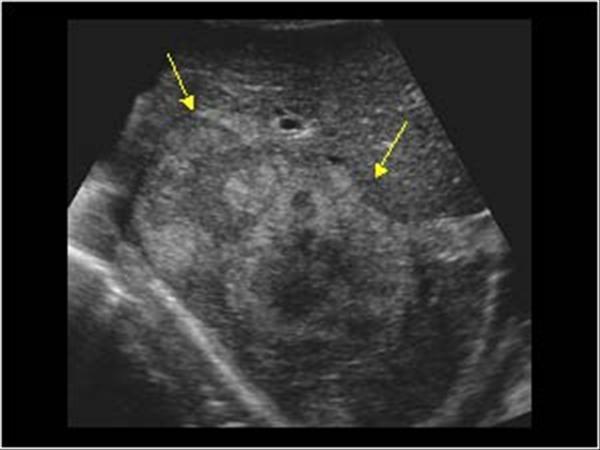 Ultrasound: both AASLD and EASL recommend 6 monthly USS USS is currently the only screening