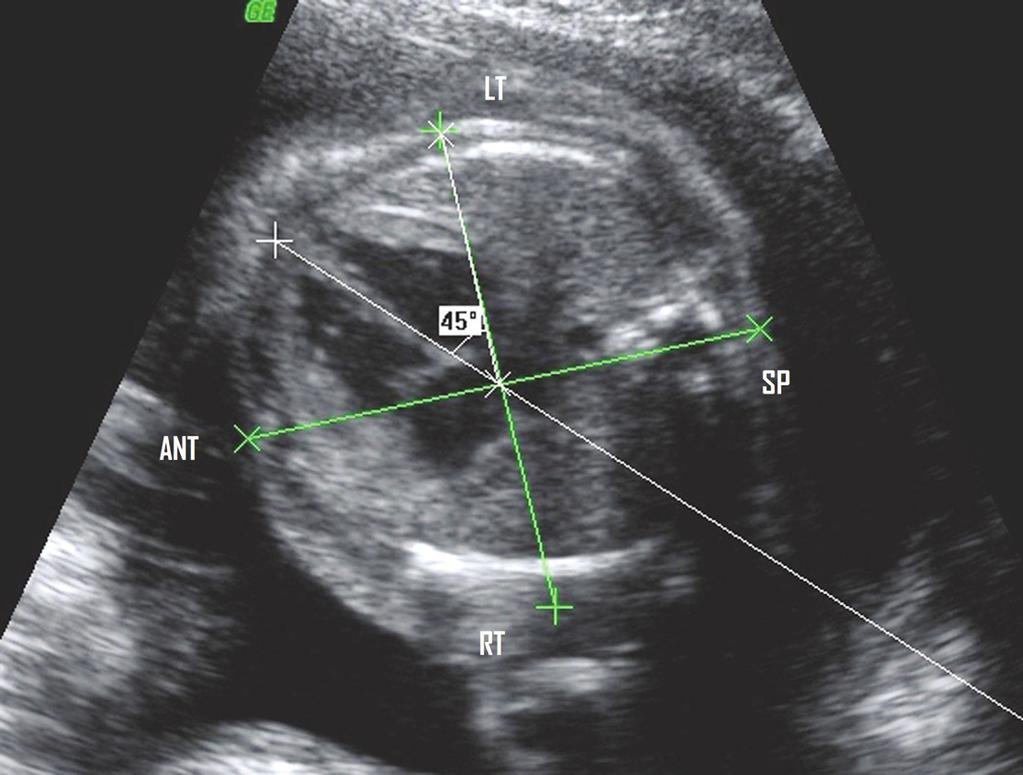 FETAL ECHOCARDIOGRAPHY AND THE ROUTINE OBSTETRIC SONOGRAM / Zimbelman, Sheikh 145 TABLE 3. Four-Chamber View FIG. 2. Cardiac axis.