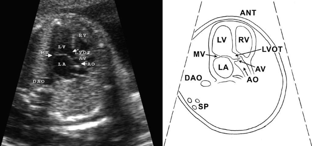 RV, right ventricle; LV, left ventricle; RA, right atrium; LA, left atrium; DAO, descending thoracic aorta; SP, spine; FO, foramen ovale; MV, mitral valve; TV, tricuspid valve; ANT, anterior; IVS,