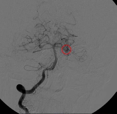 Arteriovenous Malformation 2 26 year old, underwent MRI/MRA that