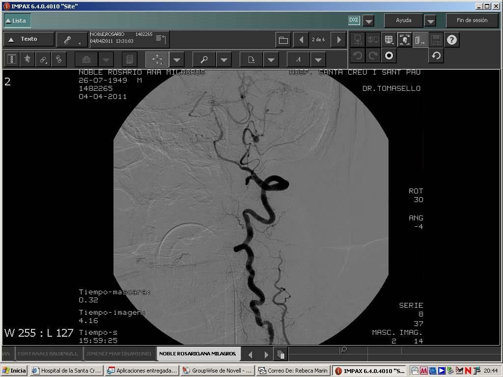 Arteriovenous Malformation 3 Angiogram done confirming an AVM, with feeding artery