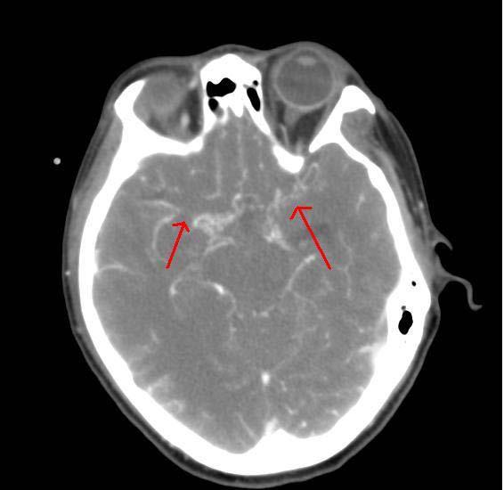 Moyamoya 39 year old with IVH, caudate bleed and hx of cocaine use enrolled without a CTA or