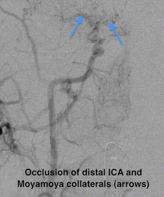 occlusions and Moyamoya collaterals Catheter angiogram confirmed diffuse Moyamoya and