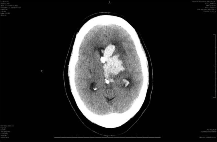 ACom Aneurysm 34 year old patient