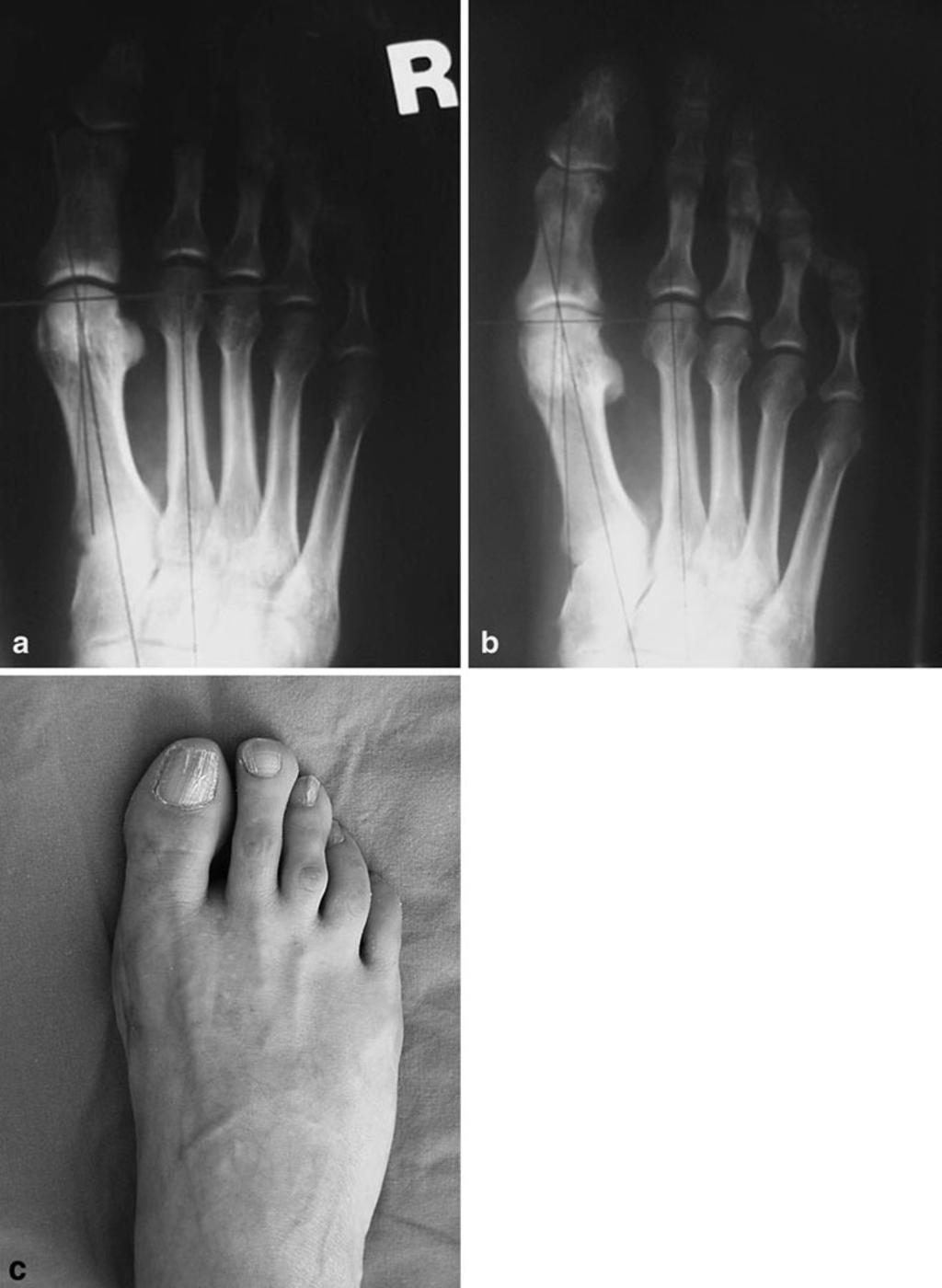 J Orthopaed Traumatol (2010) 11:89 97 93 Fig. 1 a Preoperative radiograph of the right foot of a 50-year-old female patient (HVA 25, 1 2.IMA 11, 1.DMAA 6 ).