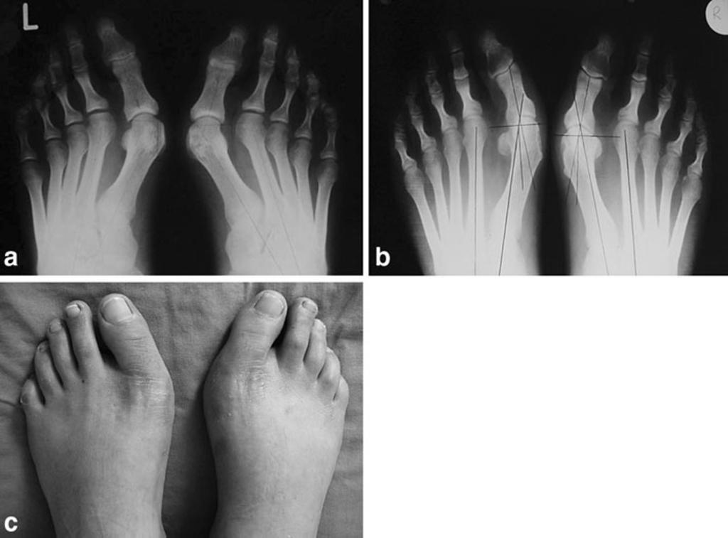 94 J Orthopaed Traumatol (2010) 11:89 97 Fig. 2 a Preoperative radiograph of the feet of a 27-year-old female patient (right HVA 50, 1 2.IMA 13, 1.DMAA 26 ; left HVA 50, 1 2.IMA 14, 1.DMAA 24 ).