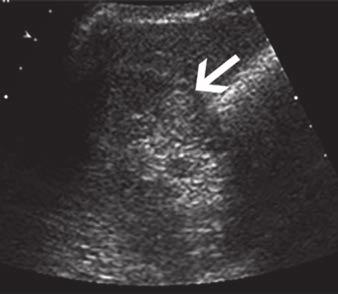 A Fig. 2 65-year-old man with hyperechoic renal lesion corresponding to presumed renal cell carcinoma. A, Ultrasound image shows 1-cm hyperechoic lesion (arrow) in midpole of right kidney.
