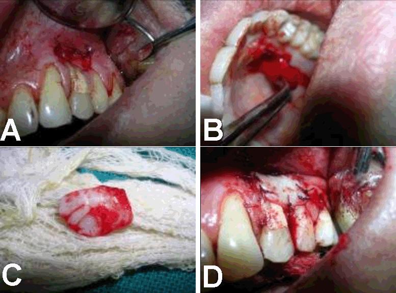 It is essential to carry out root coverage surgery whenever concerns such as aesthetics, sensitivity, susceptibility to root caries, pulpal symptoms due to exposure of root, food lodgment and plaque