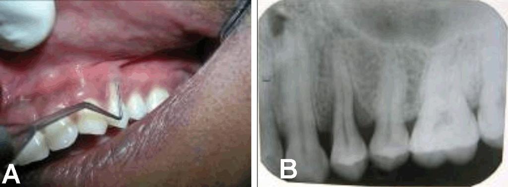 3 Figure 4: (A) Millers Class III recession of 24, (B) Radiograph showing periapical lesion and infrabony defect at distal aspect.