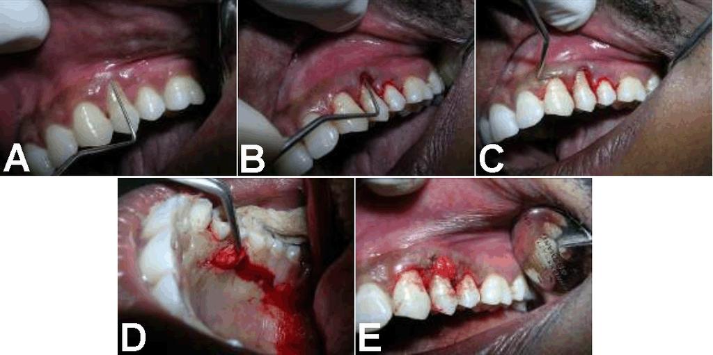 At the time of review, two months later the tooth appeared healthy. However, the patient was unable to keep the tooth completely plaque free due to the recession.