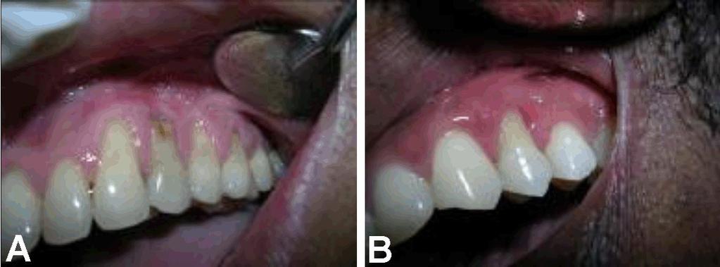 In both the cases after the primary lesion was treated, the two step surgery helped in not only creating a zone of attached gingiva but also enhancing the thickness of the attached gingiva (Figure 7A
