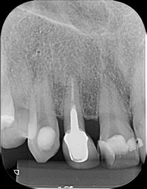 Figure 03. Initial radiography Figure 04. Tomographic image demonstrating the transportation of the foramen on tooth 11 Figure 05.