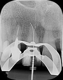 Figure 07. Radiographic image of endodontic file positioned in the apical deviation of tooth 11 Figure 09.