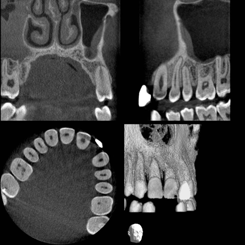 Restoring the dentition Caries detection