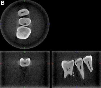 Caries detection: Approximal Studies included used a valid reference (index) standard Seven studies of proximal caries: Tsuchida et al.