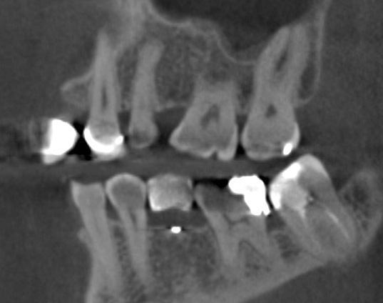 Caries detection CBCT is not indicated as