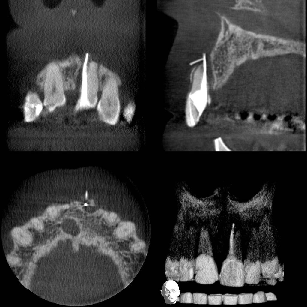 CBCT is not indicated as a standard method