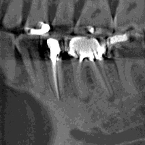 Surgical Endodontic Treatment Limited literature Use of CBCT as part of planning and performing surgical procedures seems capable of justification on empirical grounds CBCT may be indicated