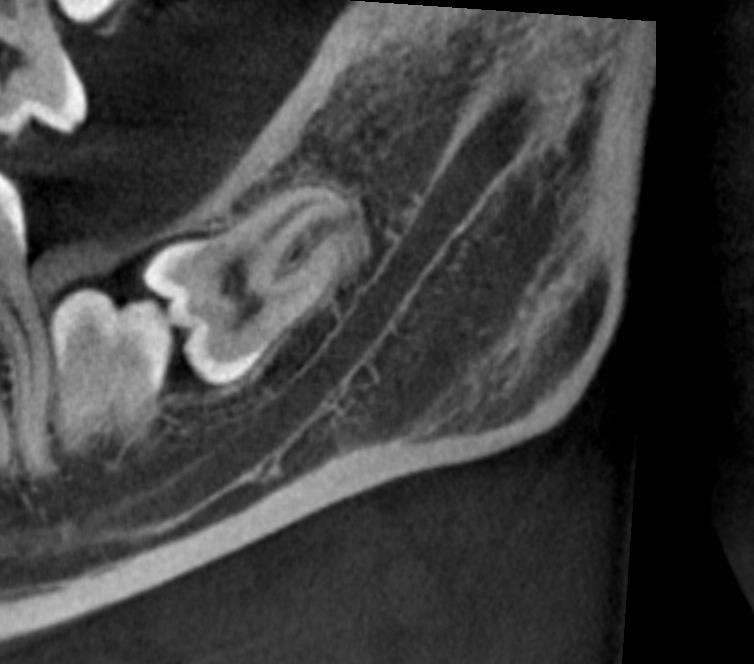 Large number of studies Conclusions are that CBCT offers advantages for the surgeon in showing the anatomical position of mandibular third molars were there is a close relationship to the ID canal.