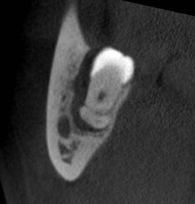 CBCT may be indicated for pre-surgical