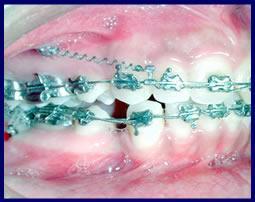Temporary Orthodontic Anchorage Using mini-implants Several studies conducted