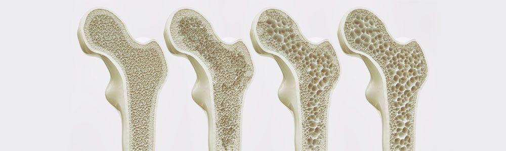 Introduction Osteoporosis is a disease caused principally by the significant loss of bone mineral density (BMD).