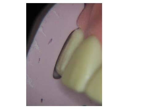 The aesthetic and functional diagnostic wax up (the key to success) Porcelain veneers o From no prep to full coverage o Preparation