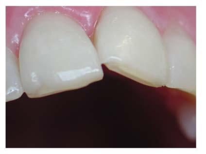 orthodontics, composite bonding or indirect restorations Understand the role of the diagnostic wax up as the key to functional and aesthetic