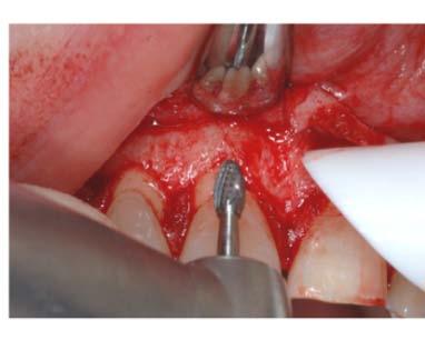 concept in aesthetic and implant dentistry Lasers or electro-surgery?