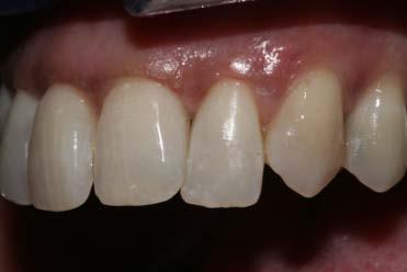 caries Treatment of Black Triangles Diastema closure and reshaping of undersized peg lateral teeth By the end