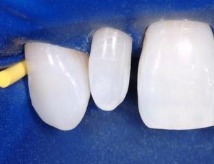 including anterior cavity design using the infinity margin, injection moulding, and the 2-step Bioclear