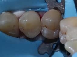 Black cavity design to Clark Modern Composite Restoration New science of strong posterior restorations and teeth