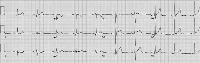 J Arrhythmia Vol 26 No 2 21 Figure 1 A typical ECG of a 58-year-old man. Arrows indicate elevation of ST segment corresponding to early repolarization. malignant ventricular arrhythmia.