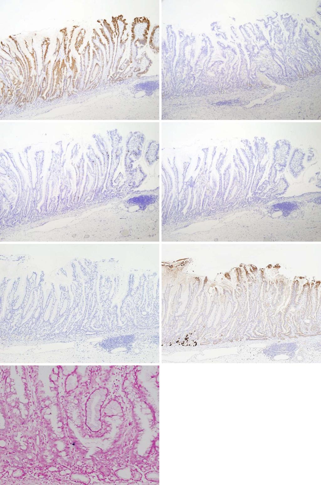 MUC5AC MUC6 MUC2 CD10 Pepsinogen I H + /K + -ATPase EVB-ISH Figure 3. Immunohistochemical and in situ hybridization analyses of the tumor cells.